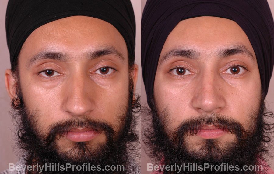 front view - Male before and after Rhinoplasty