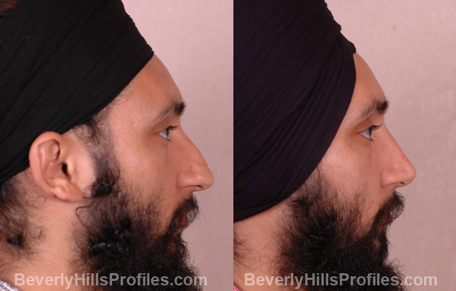 side view - Male before and after Rhinoplasty