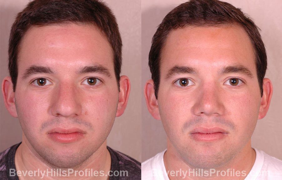 front view - Male patient before and after Rhinoplasty