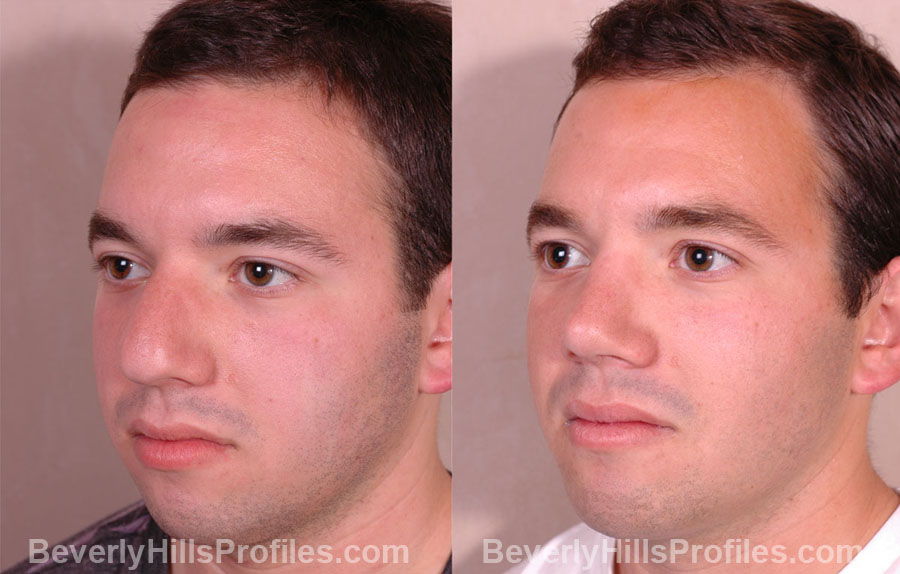 oblique view - Male patient before and after Rhinoplasty
