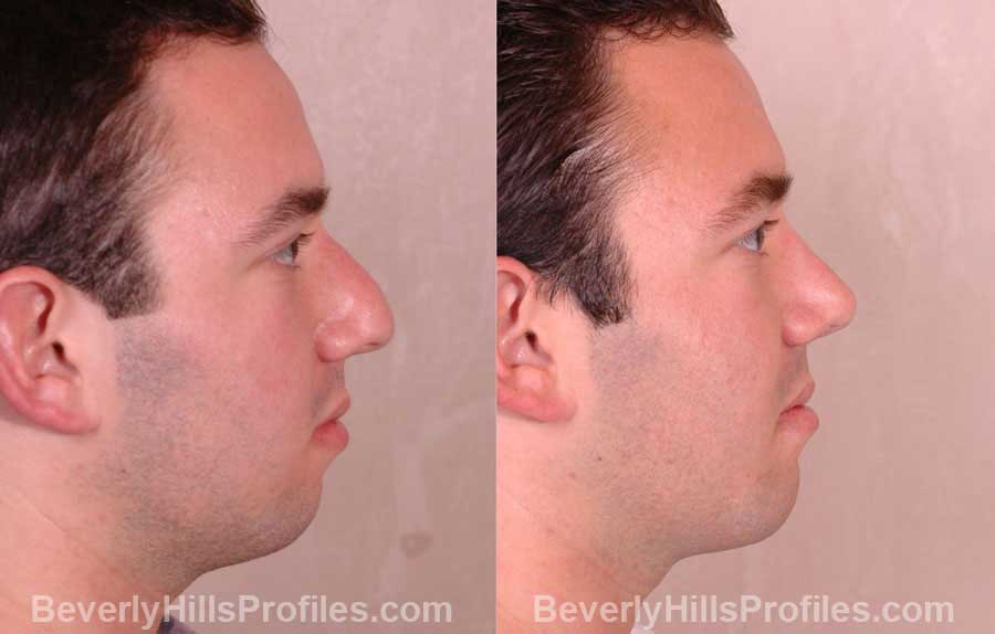 side view - Male patient before and after Rhinoplasty