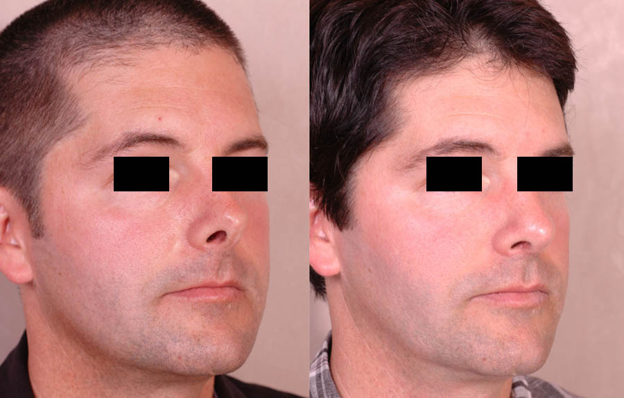 oblique view - Male patient before and after Nose Job