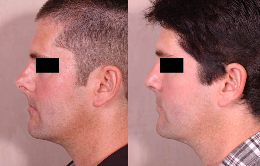 side view - Male patient before and after Nose Job