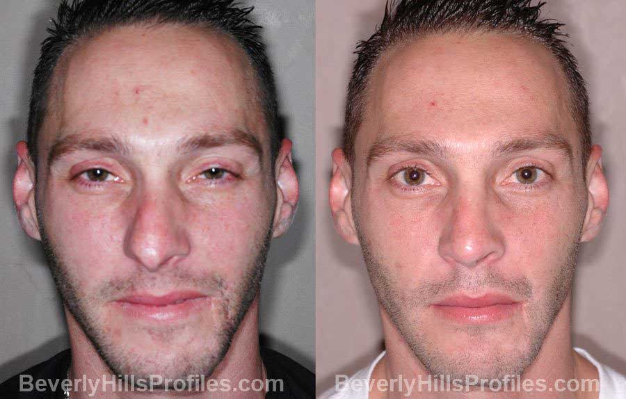 front view - Male before and after Nose Job