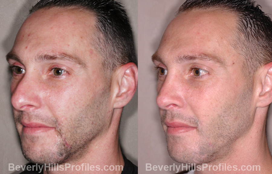 oblique view - Male before and after Nose Job