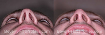 underside view - Male before and after Nose Job