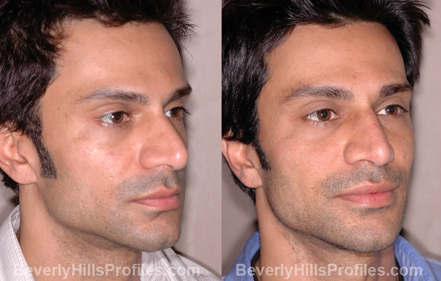 Male before and after Nose Job - oblique view