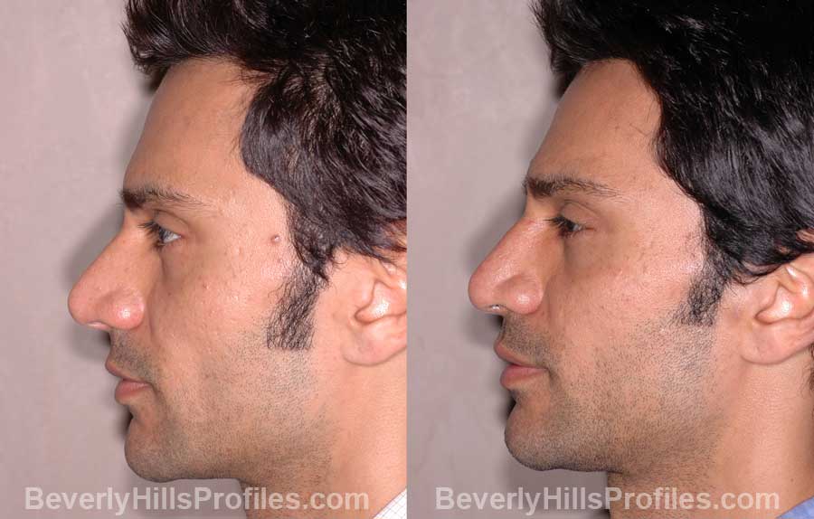 Male before and after Nose Job - side view
