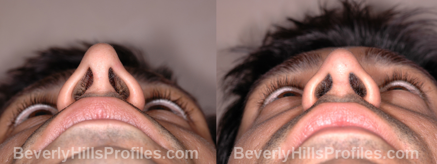 Male before and after Nose Job - underside view