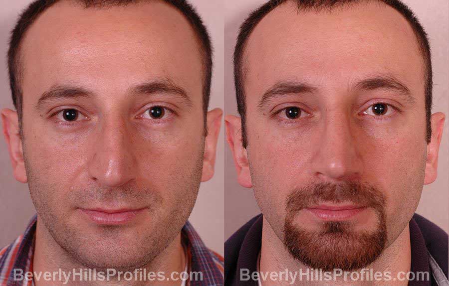 Rhinoplasty Before After Photos Beverly Hills LA Rhinoplasty