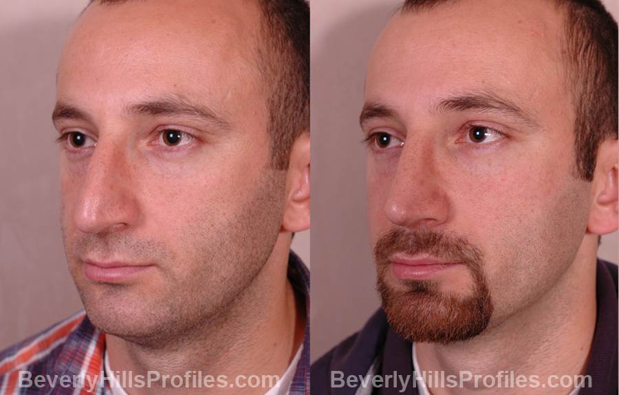 pics Male before and after Nose Job - oblique view