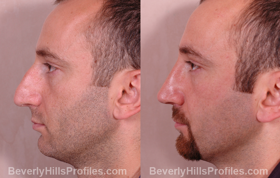 pics Male before and after Nose Job - side view
