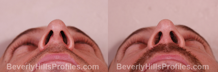 pics Male before and after Nose Job - underside view