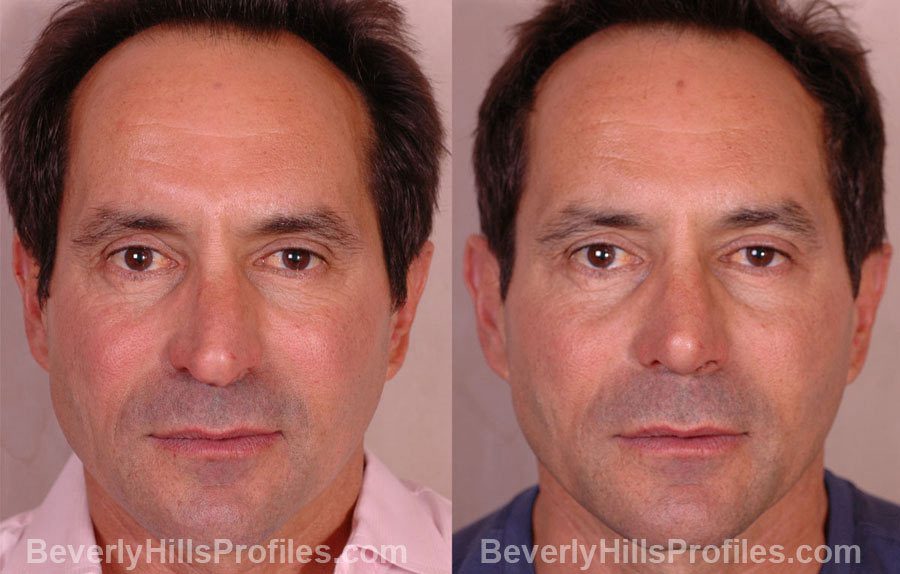 imgs Male before and after Nose Job - front view