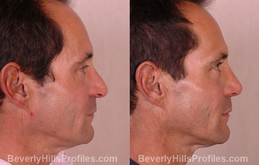 imgs Male before and after Nose Job - side view