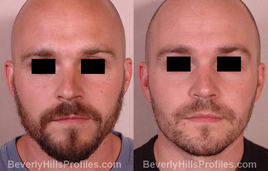 pics Male before and after Nose Job front view