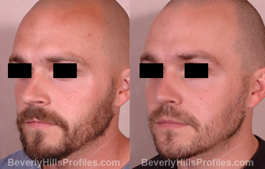 pics Male before and after Nose Job oblique view