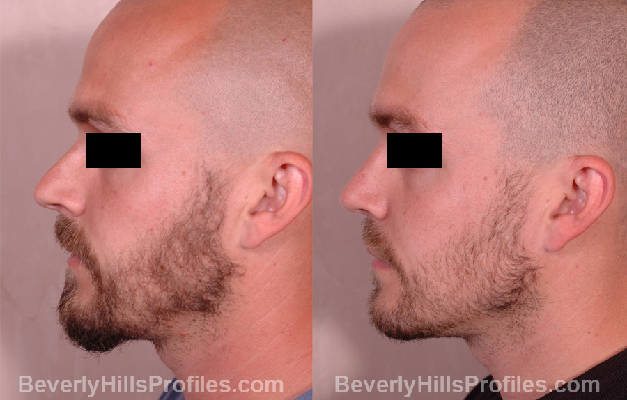 pics Male before and after Nose Job side view