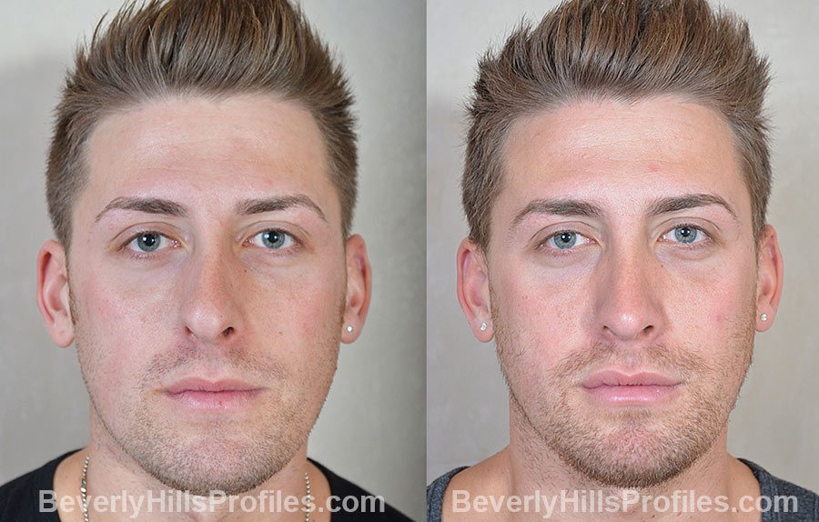 Male patient before and after Rhinoplasty - front view