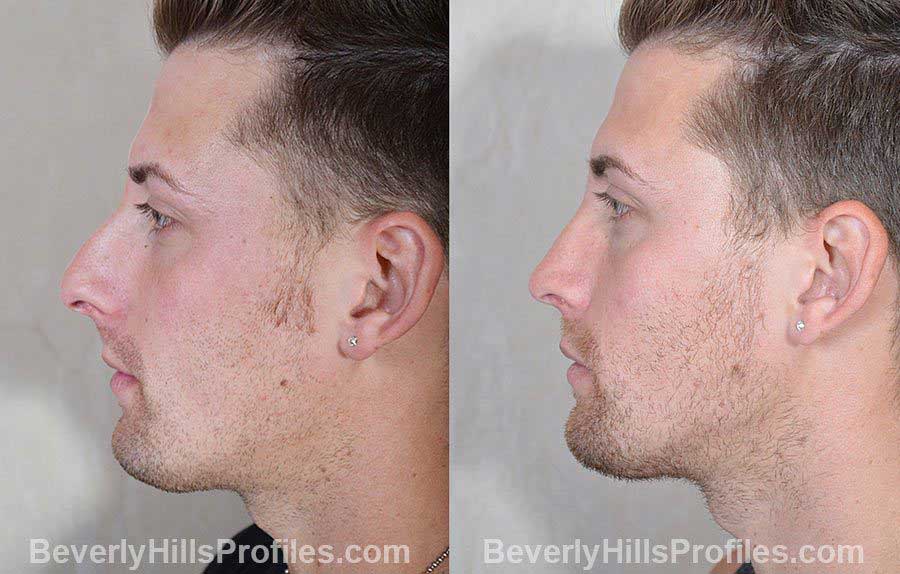 Male patient before and after Rhinoplasty - front view