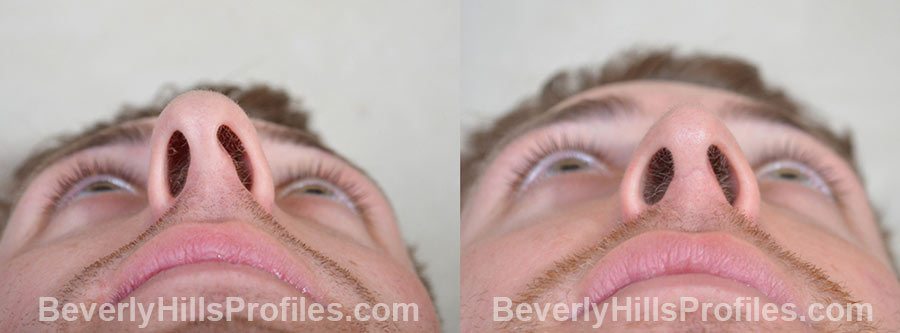 Male patient before and after Rhinoplasty - underside view