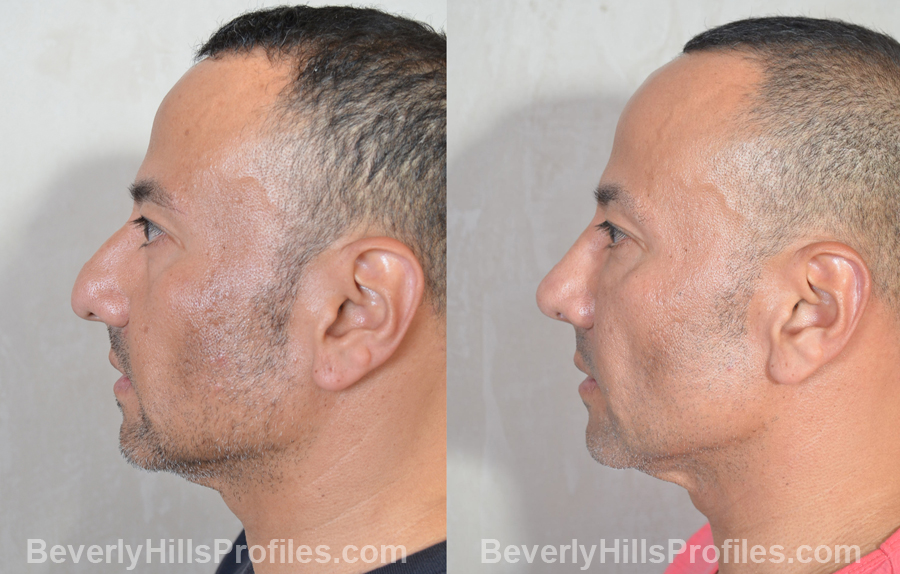 Male before and after Nose Surgery side view