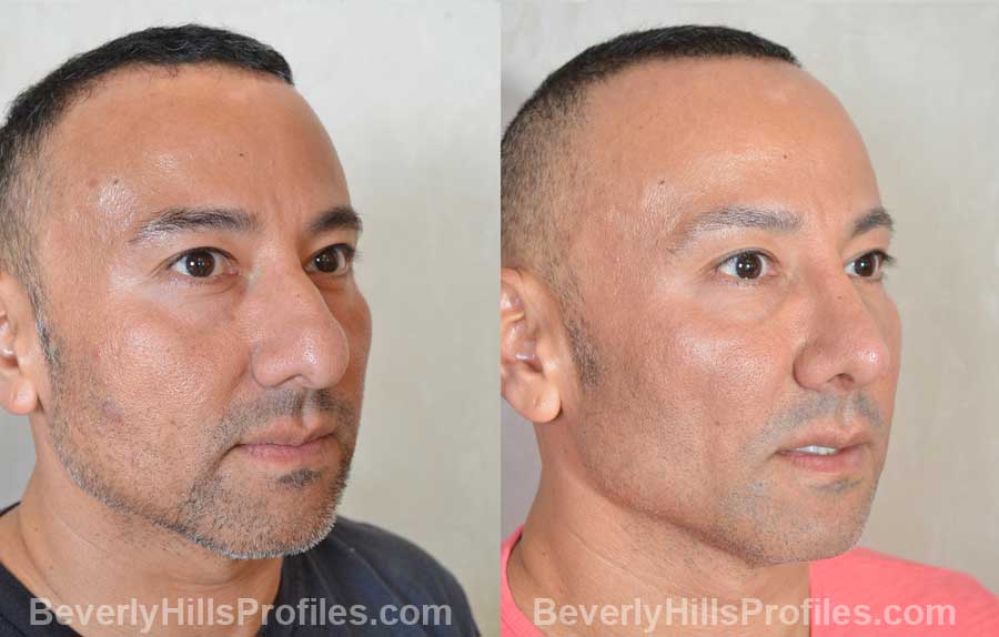 Male before and after Nose Surgery oblique view