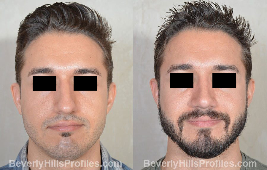 Male patient before and after Rhinoplasty, front view