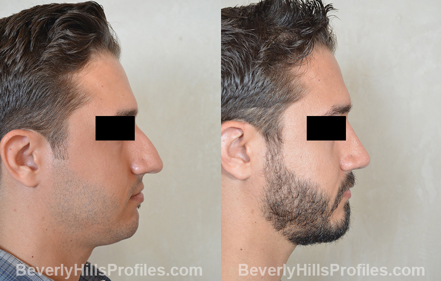 Male patient before and after Rhinoplasty, side view