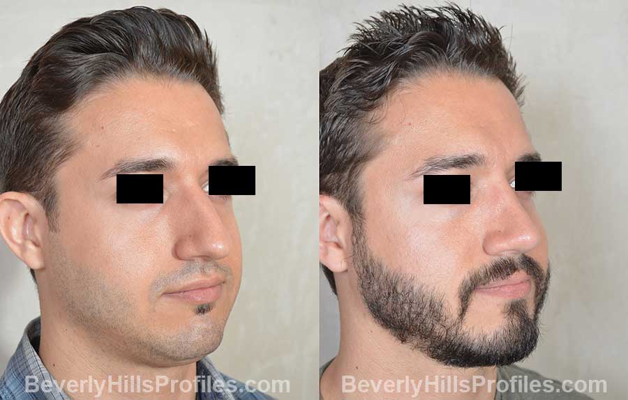 Male before and after Rhinoplasty, oblique view