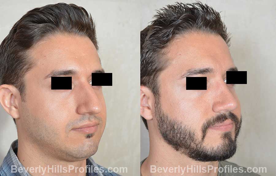 Male patient before and after Rhinoplasty, front view