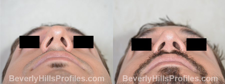Male before and after Rhinoplasty, photo