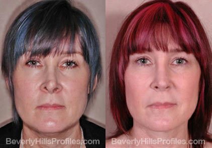before and after Necklift Procedures - front view