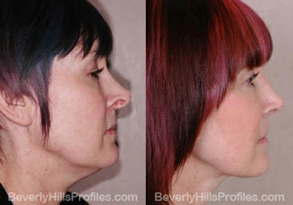 before and after Necklift Procedures - right side view