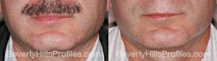 pics before and after Necklift - front view