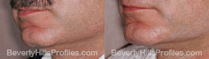 pics before and after Necklift - left oblique view