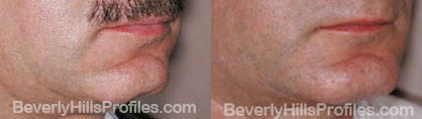 pics before and after Necklift - oblique view