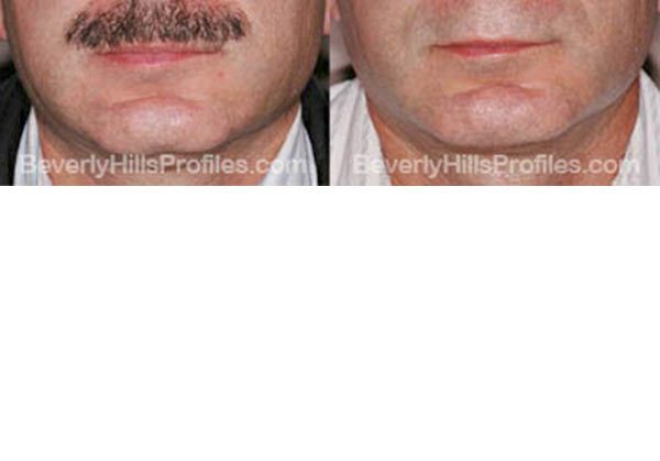 pics before and after Necklift