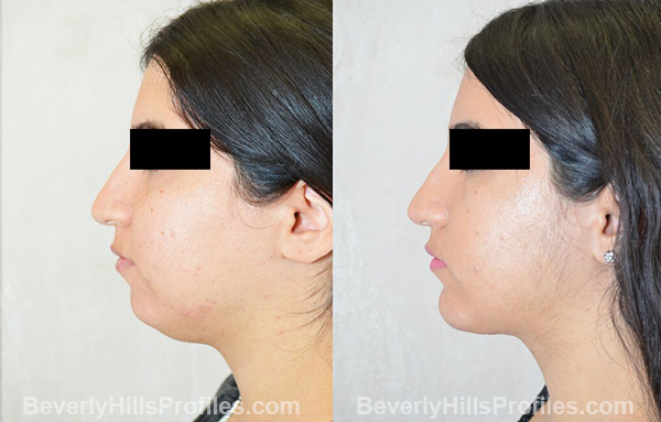 photos before and after Necklift Procedures - left side view