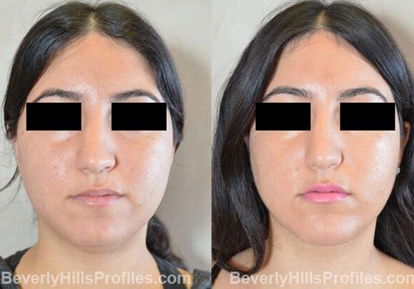 photos before and after Necklift Procedures