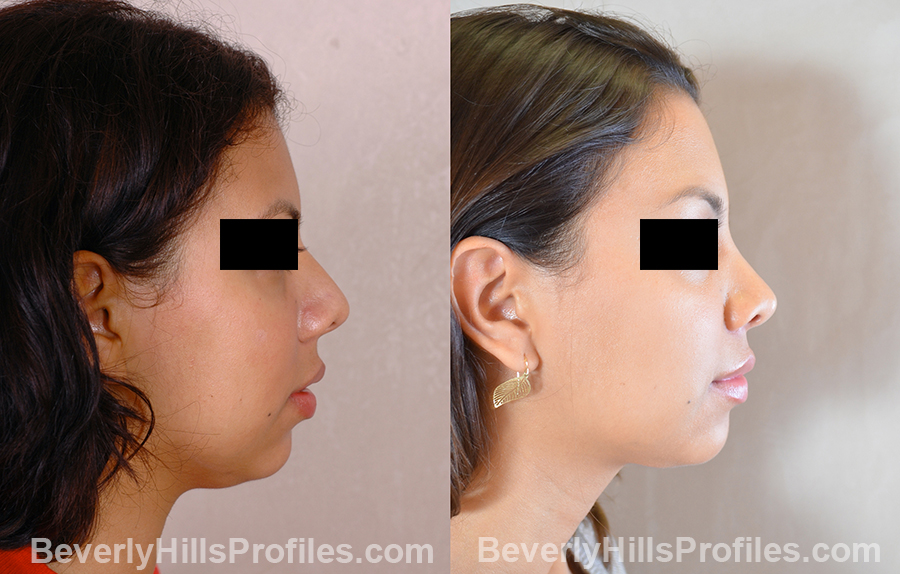 right side view before and after Necklift