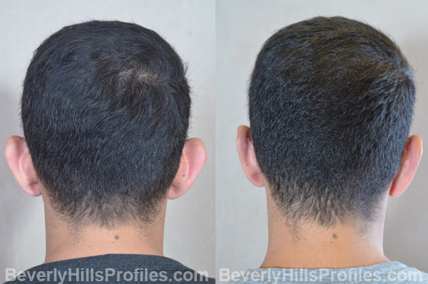 photos male patient before and after Otoplasty - back view