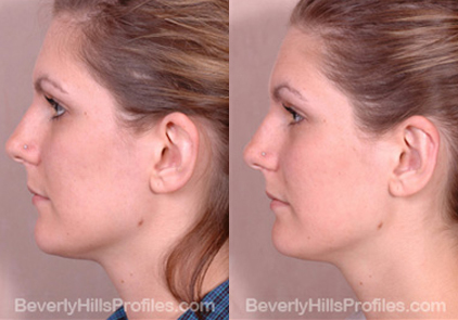 photos female patient before and after Otoplasty - left side view