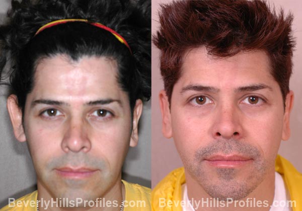 male patient before and after Otoplasty - front view