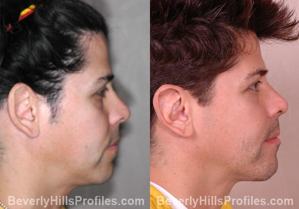 male patient before and after Otoplasty - right side view