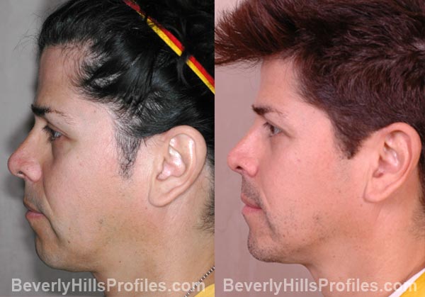 male patient before and after Otoplasty - left side view