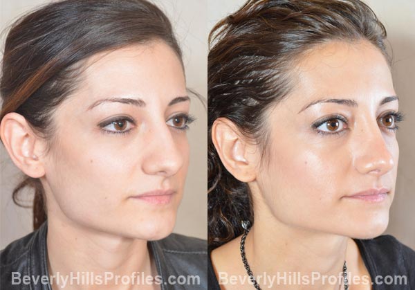 oblique photos - Female before and after Otoplasty