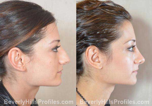 side photos - Female before and after Otoplasty