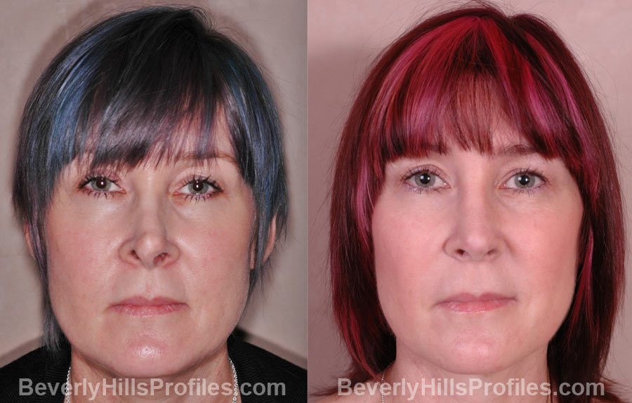 Revision Rhinoplasty Before and After Photos - female, front view, patient 1