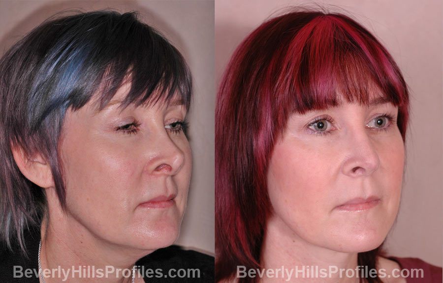 Revision Rhinoplasty Before and After Photos - female, right side oblique view, patient 1
